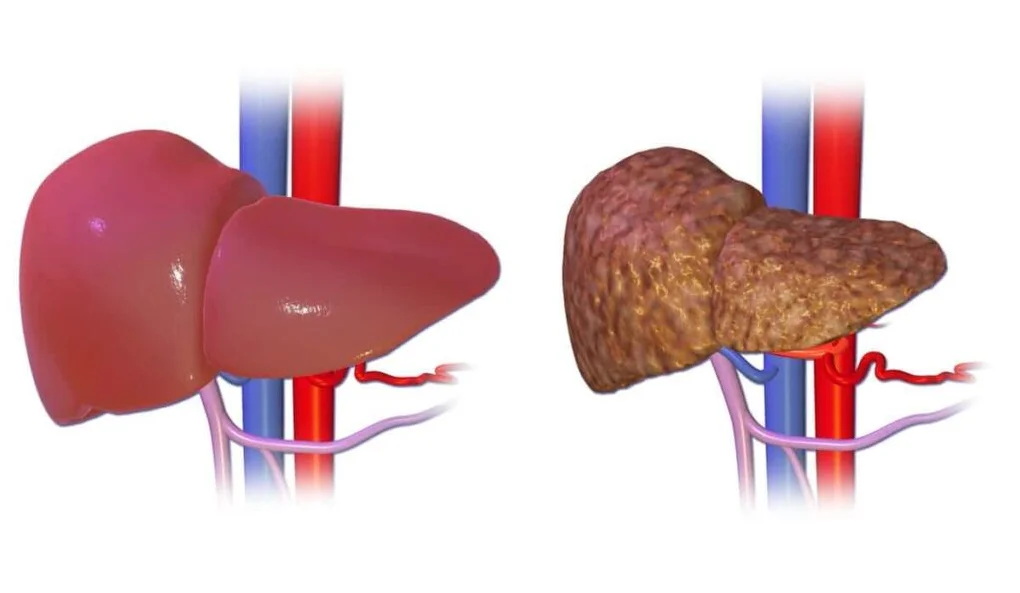 Ficat normal vs ciroza